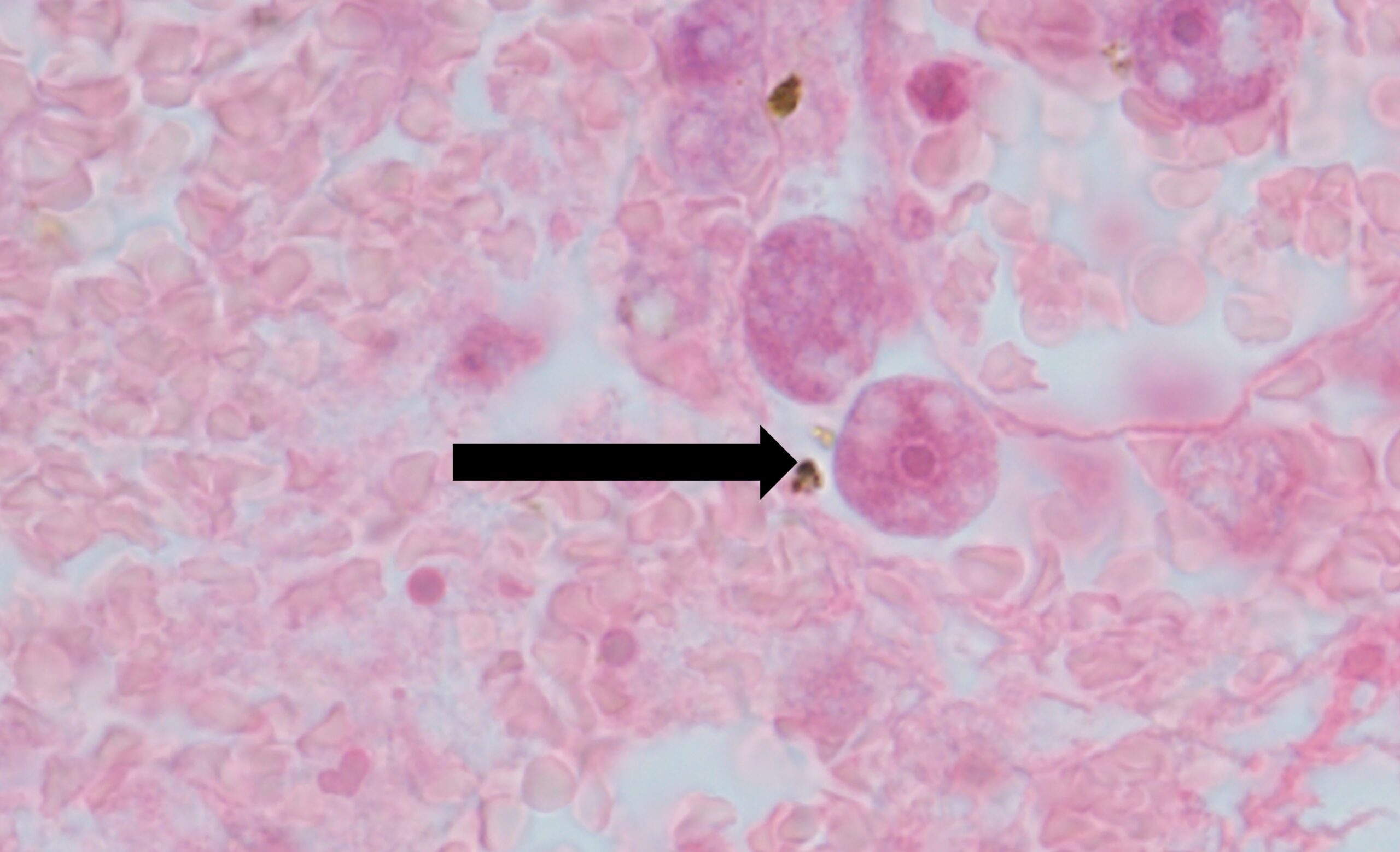 Arrow points to Acanthamoeba in a patient's brain.