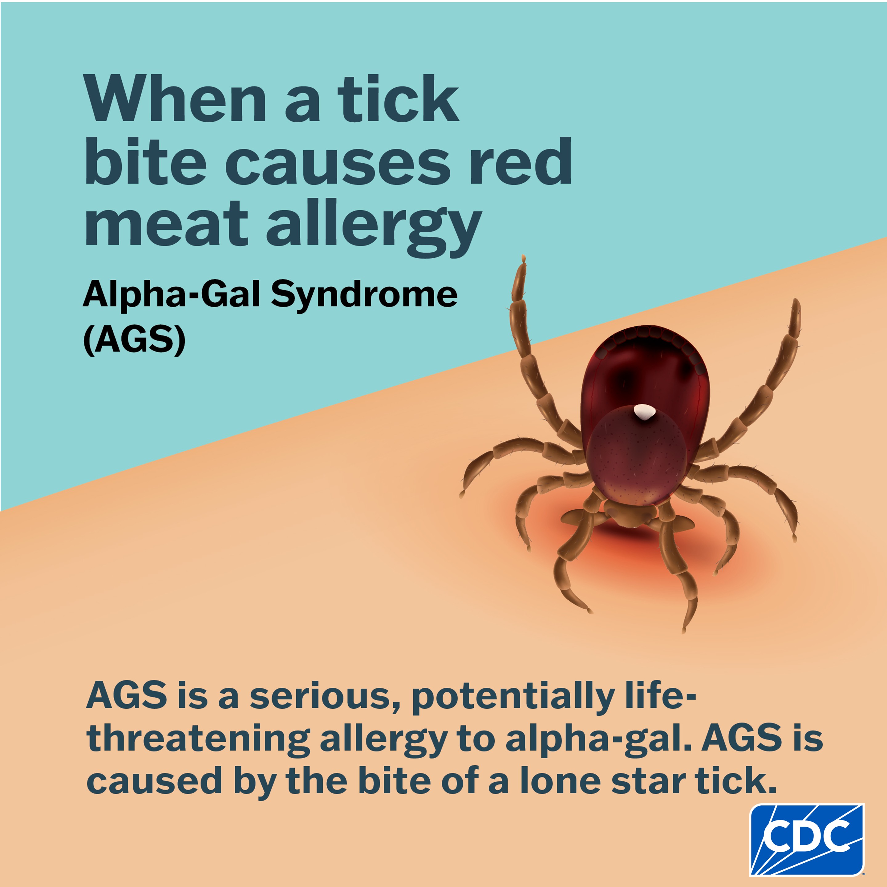 A graphic showing that AGS is an allergy, which can develop after a tick bite.