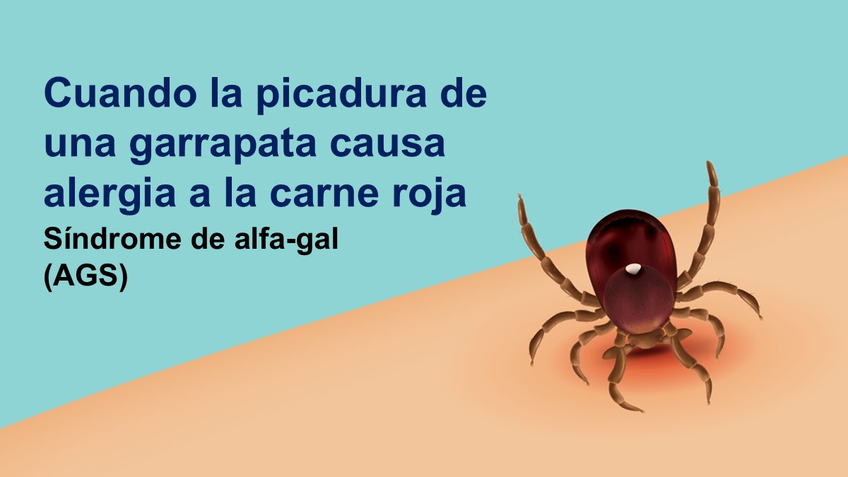 Gr&aacute;fica de una garrapata picando a una persona con texto superpuesto acerca del s&iacute;ndrome de alfa-gal.