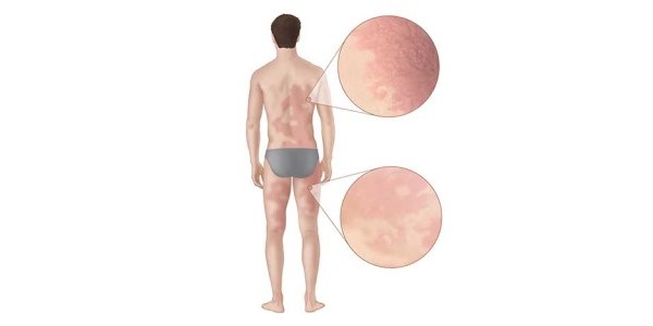 La urticaria o el sarpullido son síntomas comunes de una reacción del síndrome de alfa-gal.