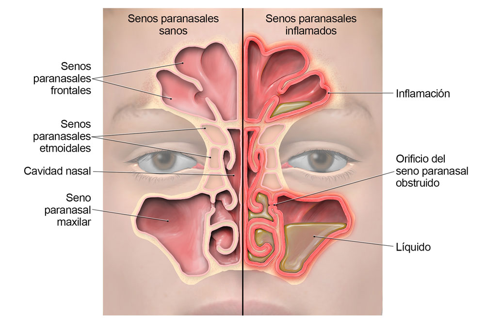 sinusitis-lg-ES.jpg Diagrama de la anatomía de los senos paranasales que muestra dónde ocurre la inflamación y dónde se acumula el líquido durante la sinusitis.
