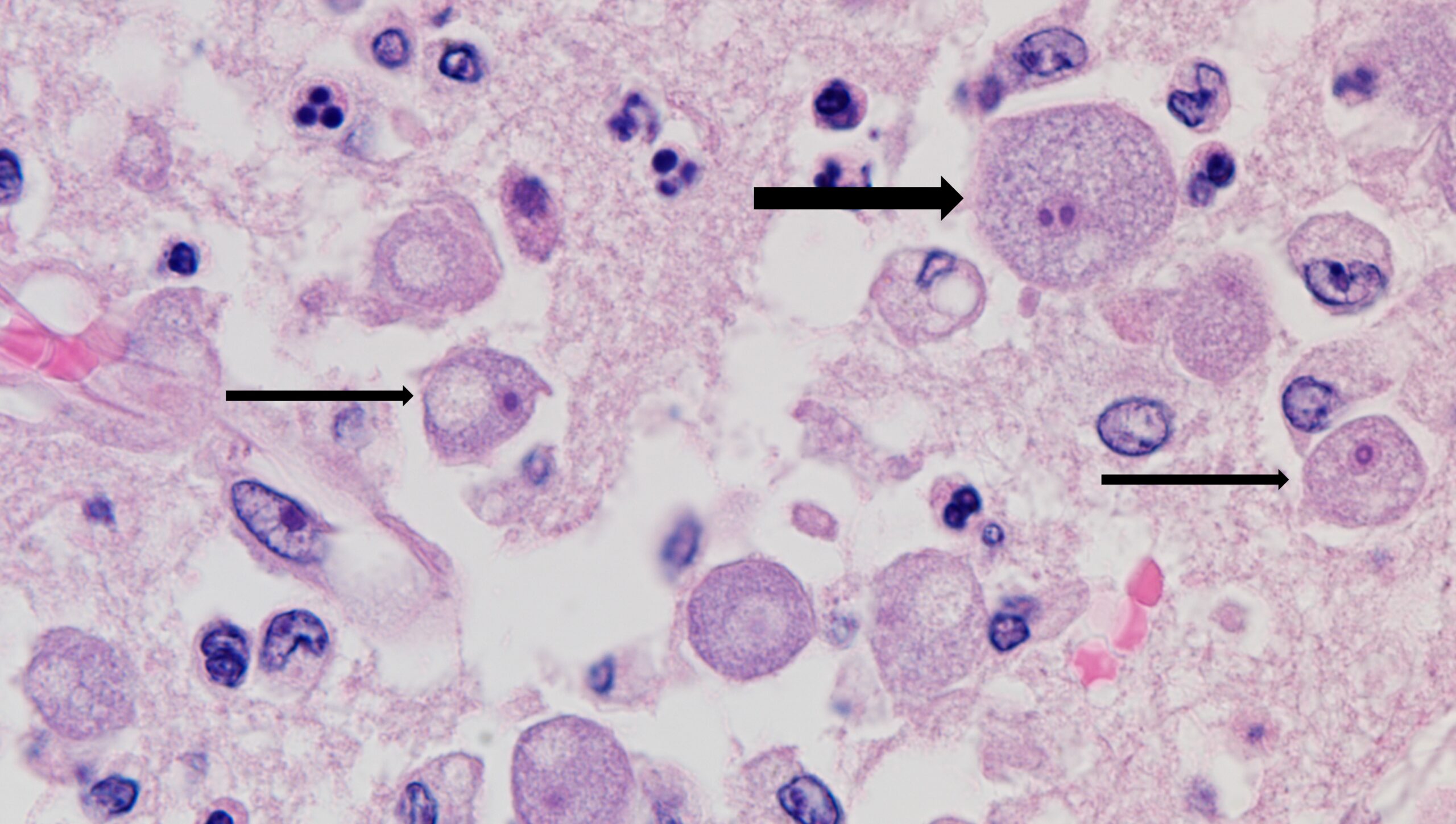 Balamuthia amebas in a patient’s brain. Thin arrows point to the infectious form of the ameba.