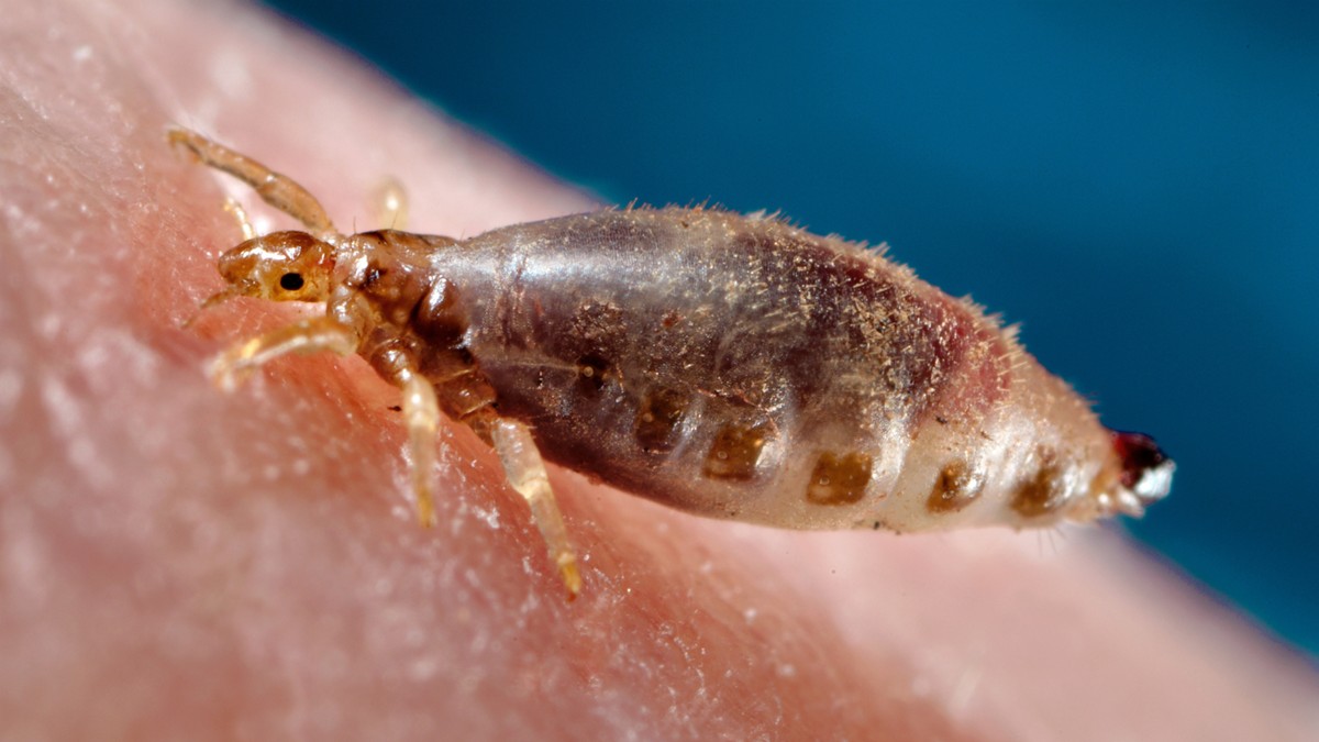 Human body louse spread Bartonella quintana.