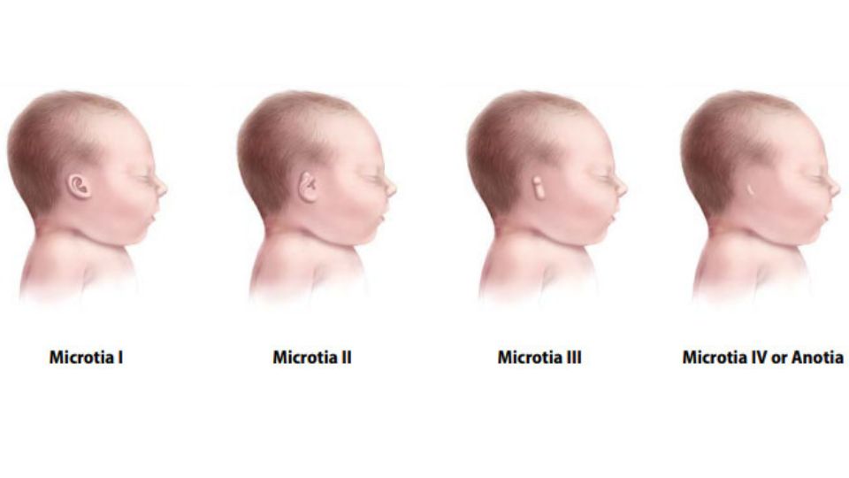 Ilustración del rango de gravedad de microtia y anotia, desde un bebé con una oreja pequeña hasta un bebé sin oído externo visible.