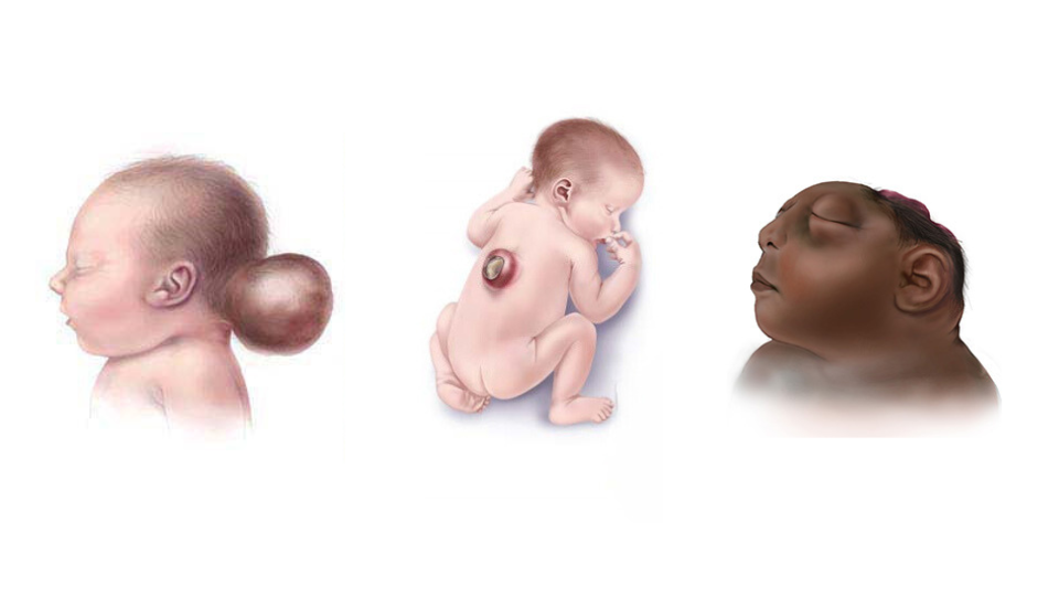 Collage of illustrations of infants with encephalocele, spina bifida, and anencephaly