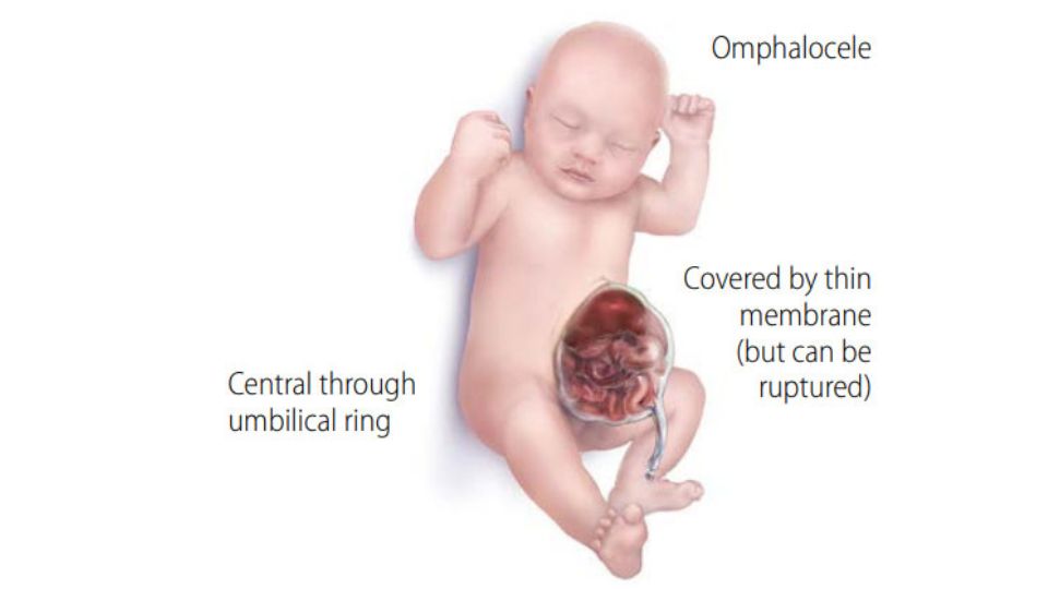 Ilustración de un bebé con onfalocele. El texto de la gráfica dice: onfalocele, central a través del cordón umbilical, cubierto por una membrana delgada (pero puede romperse).
