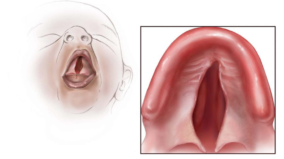 Cleft Palate Ilustración de un bebé con el paladar hendido.