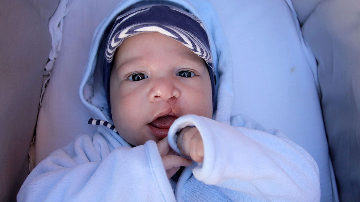 Baby with cleft lip in warm clothes Baby with cleft lip in warm clothes