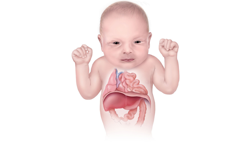 Ilustración de un bebé mostrando los órganos internos. El bebé tiene hernia diafragmática, y los órganos abdominales están en el pecho.