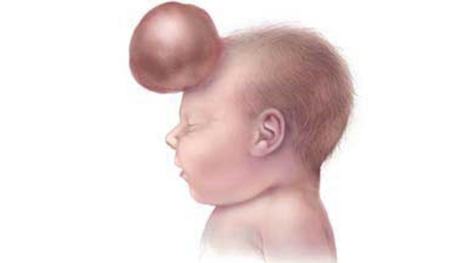 Frontal encephalocele Ilustración de un bebé con un encefalocele frontal, con la protrusión en la frente.