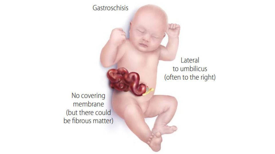 Ilustración médica de un bebé con gastrosquisis.