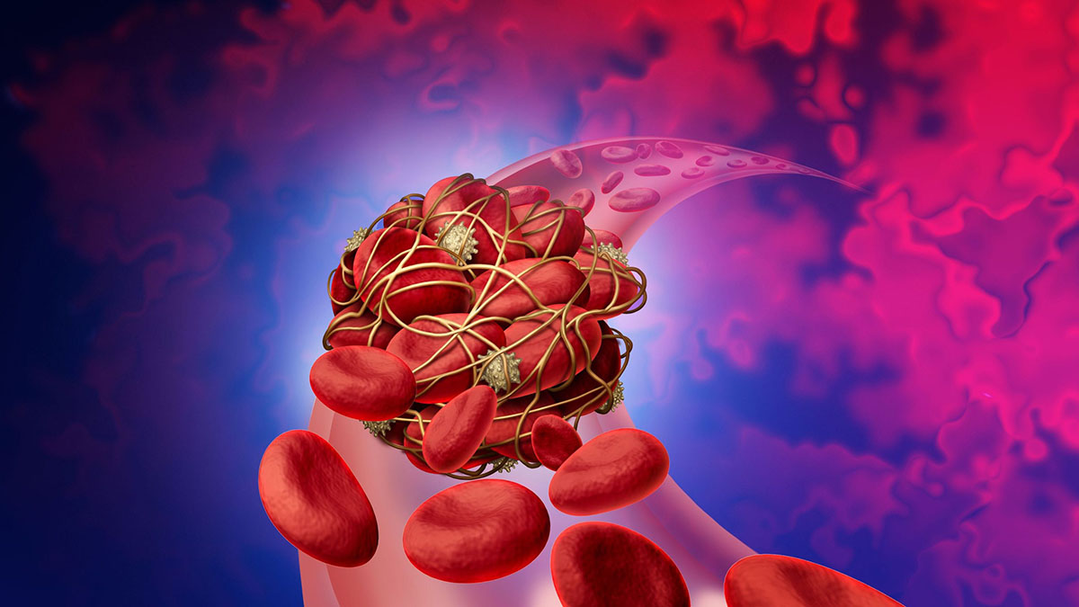 Blood Clot Horizontal Photo of blood clot in a vein