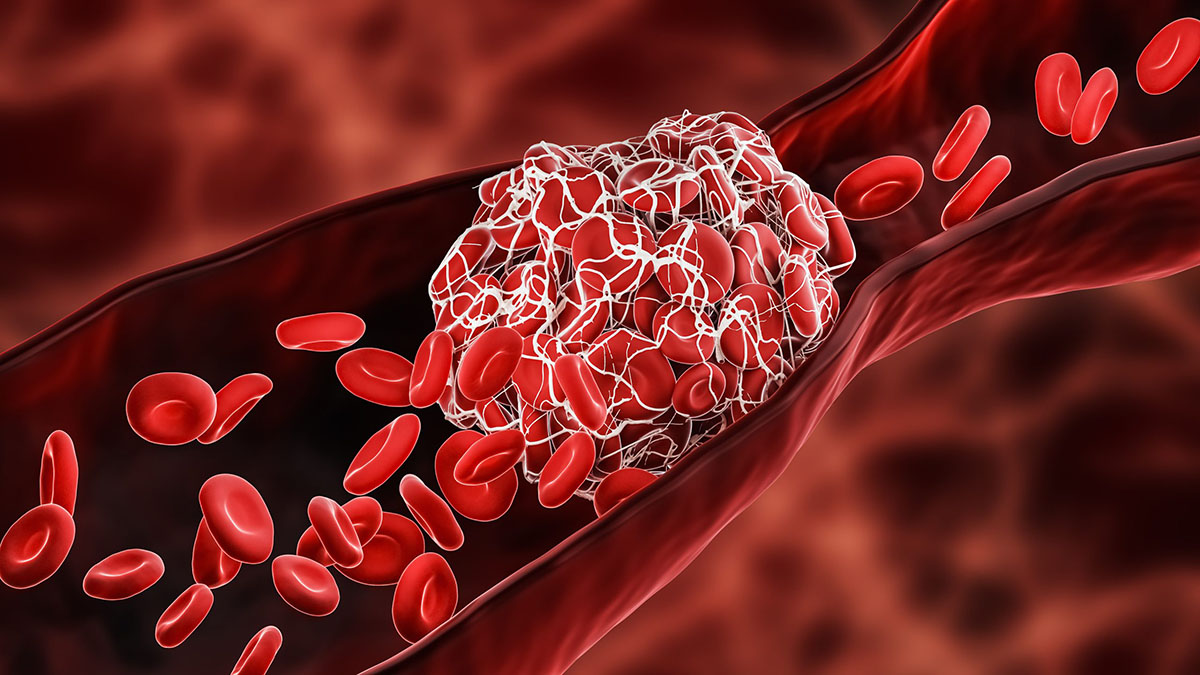 About Venous Thromboembolism (Blood Clots) Image of a blood clot (cluster of red blood cells clumped together) blocking a blood vessel