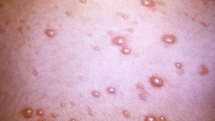 Close view of a patient&rsquo;s skin surface with a pustular-vesicular rash due to the varicella-zoster virus (VZV) pathogen.