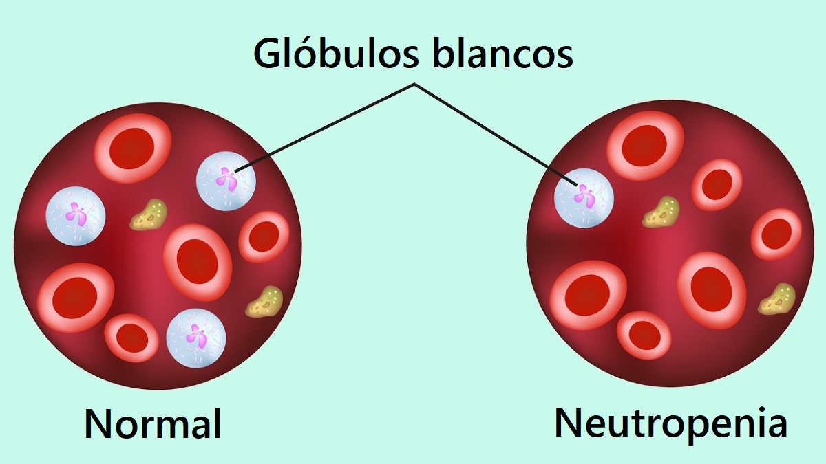 Gl&oacute;bulos blancos normales y neutropenia