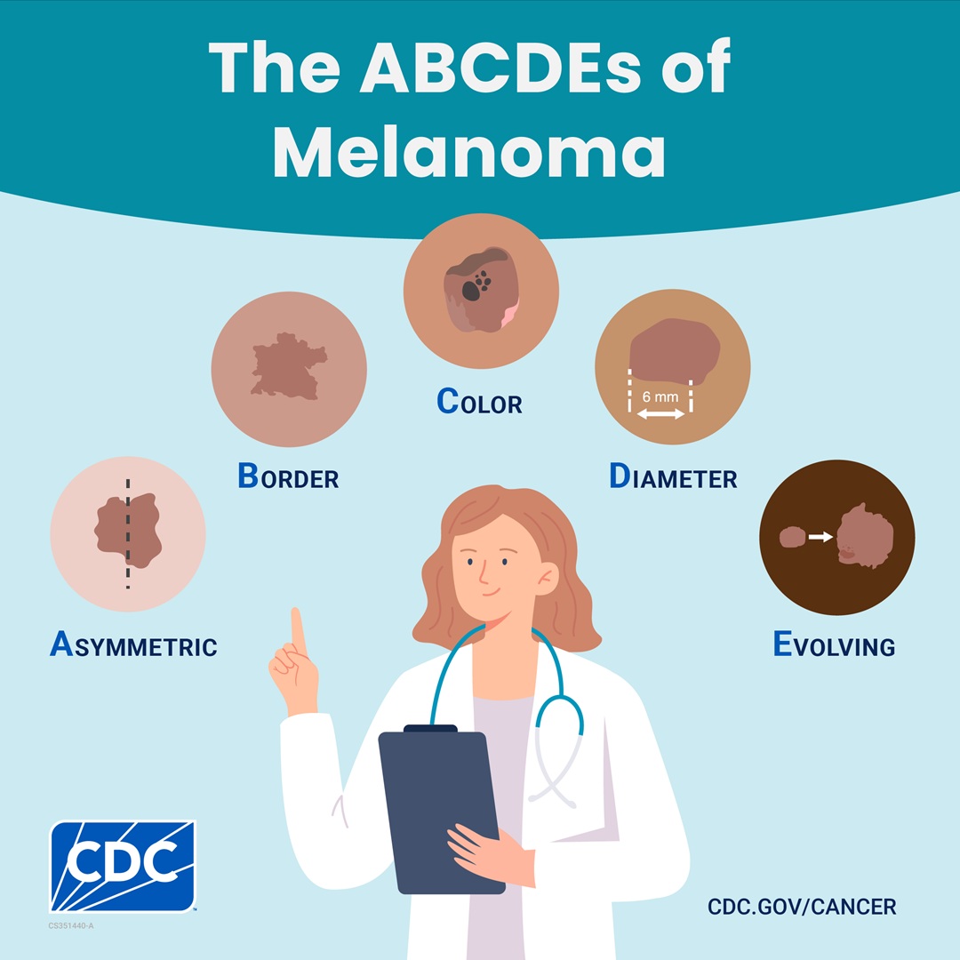 Square image: The ABCDEs of melanoma: asymmetric, border, color, diameter, evolving