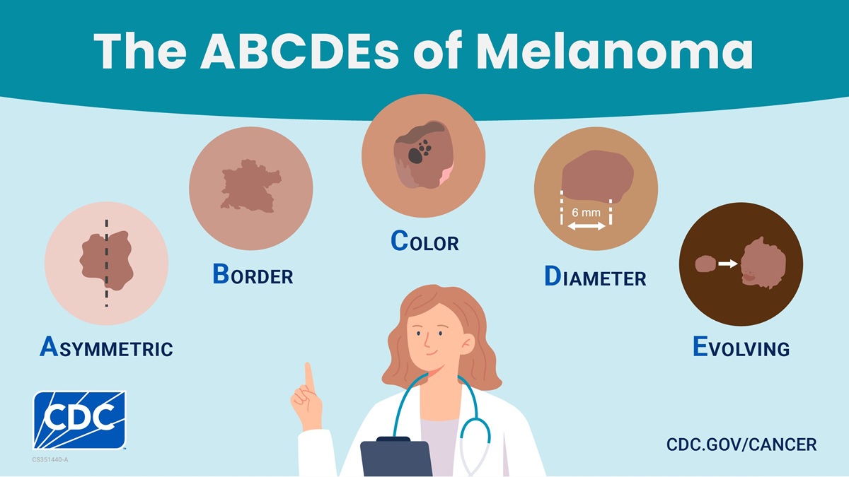 Wide image: The ABCDEs of melanoma: asymmetric, border, color, diameter, evolving