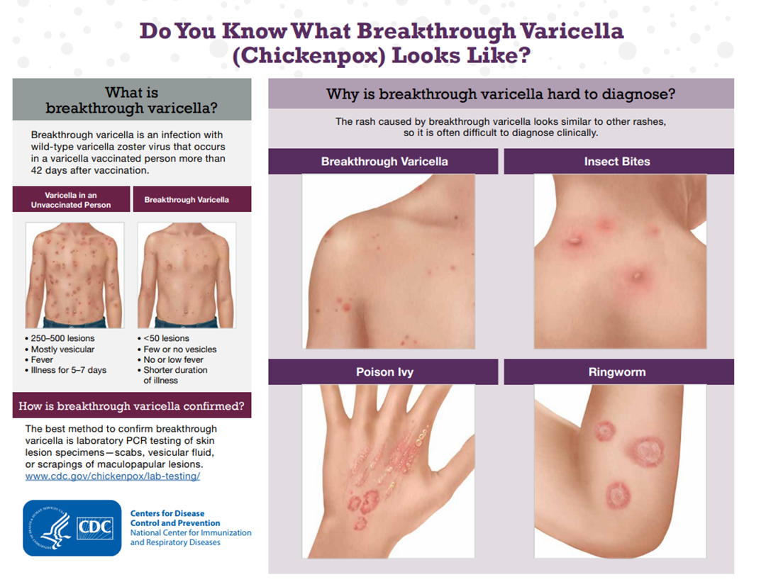 breakthrough varicella graphic Learn what breakthrough varicella (chickenpox) looks like in vaccinated people.