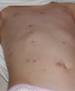 Abdomen con varicela de un niño de piel clara vacunado. Fuente: Varicella Proyecto de Vigilancia Activa de la Varicela.