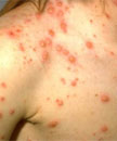 teenager with chickenpox Adolescent female with light skin with varicella lesions in various stages.