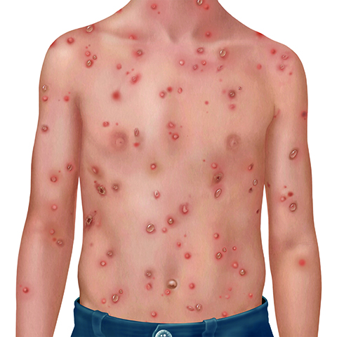 varicella rash Illustration of varicella rash.