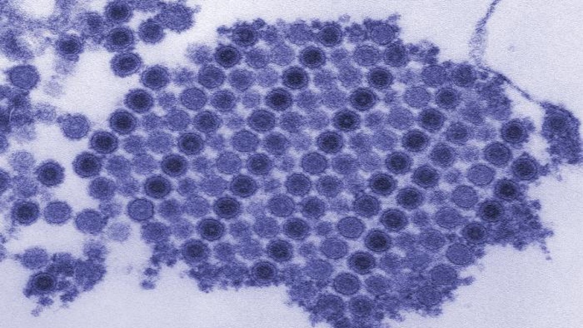 Electron microscopic image of chikungunya virus.
