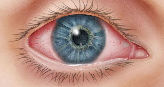 home-pink-eye Close-up of an eye with conjunctivitis or pink eye.