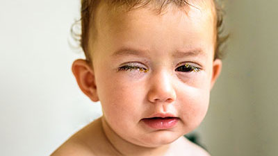 home-baby-symptoms Baby showing symptoms of pink eye like crusting of eyelids.