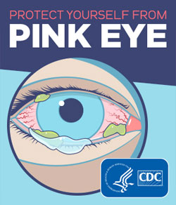 Close-up of an eye with pink eye Close-up of an eye with pink eye.