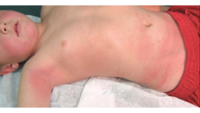 Picture of a patient exhibiting the typical rash associated with scarlet fever.