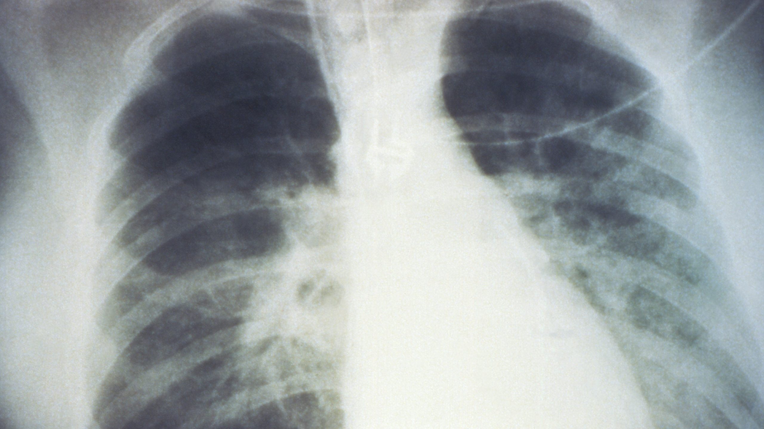 black and white chest xray