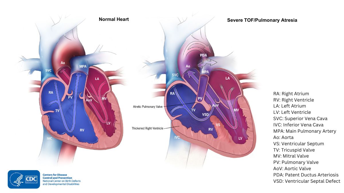 Diagram showing heart with severe TOF/pulmonary atresia and a normal heart