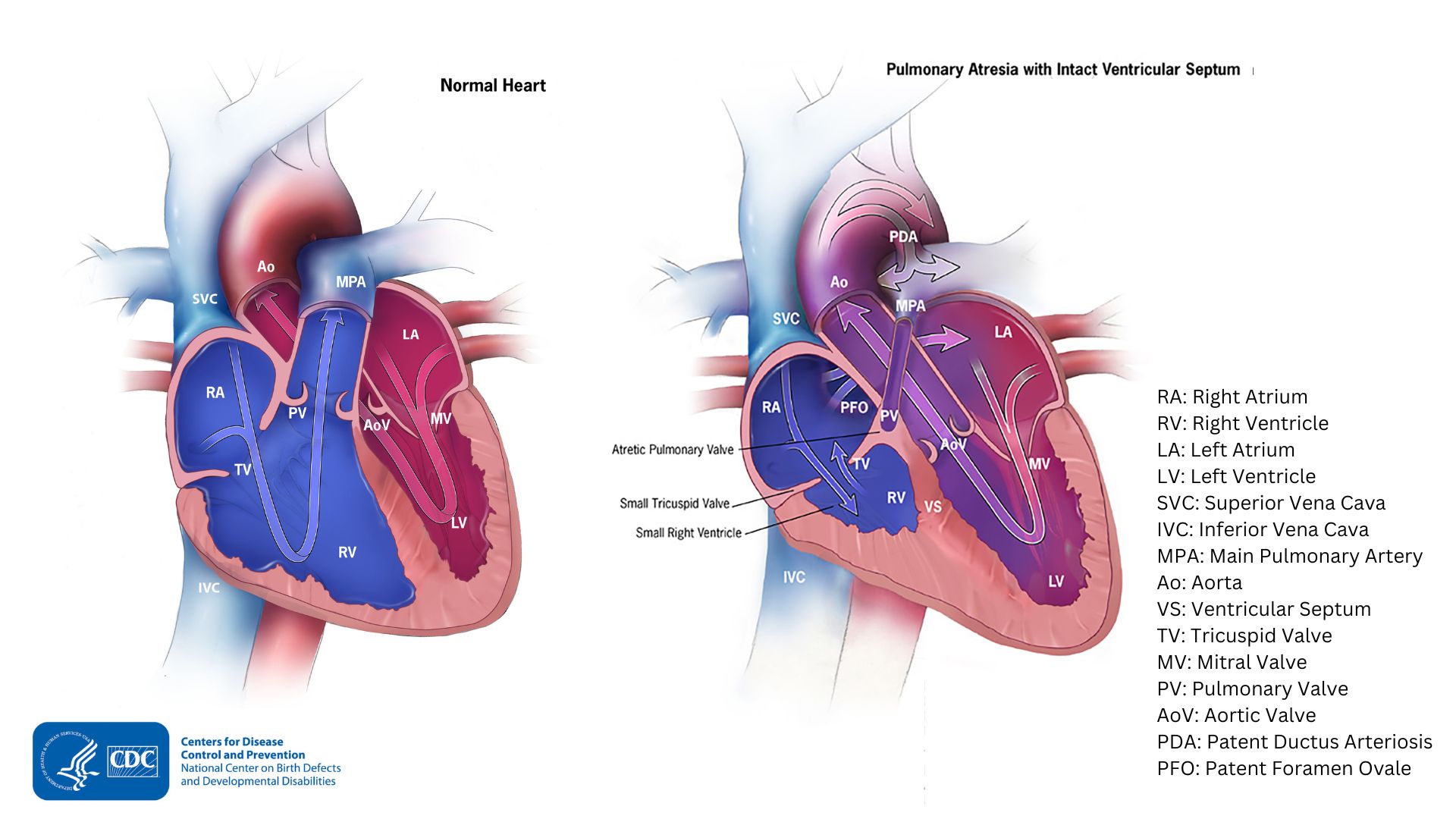 Diagram showing heart with pulmonary atresia and a normal heart