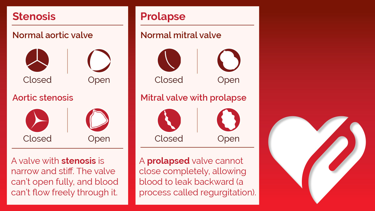 Figures with text explaining stenosis and prolapse and eight small images illustrating open and closed positions of both normal and diseased versions of aortic and mitral valves. A valve with stenosis is narrow and stiff. The value can't open fully, and blood can't flow freely through it. A normal aortic valve, when closed, has three equal-sized slice-shaped flaps within a circle that close to form a Y-shaped seal. When open, the normal aortic valve has the flaps open to form an almost perfect circular cross-section with very small protrusions into the blood flow. An aortic valve with stenosis, when closed, has flaps that do not form a Y-shaped seal, instead leaving a cavity at the junction of the flaps where blood can trickle through. When open, the flaps are not fully open, forming a smaller, triangular cross-section. A prolapsed valve cannot close completely, allowing blood to leak backward, a process called regurgitation. A normal mitral valve, when closed, has two gibbous moon-shaped flaps that forma parenthesis-shaped seal. When open, the normal mitral valve has flaps open that form an almost perfect circular cross-section with very small protrusions into the blood flow. A mitral valve with prolapse, when closed, has two gibbous moon-shaped flaps that do not seal, leaving several gaps between the valves where blood can trickle through. An open mitral valve with prolapse has flaps that do not fully open, forming a smaller, elliptical cross-section.