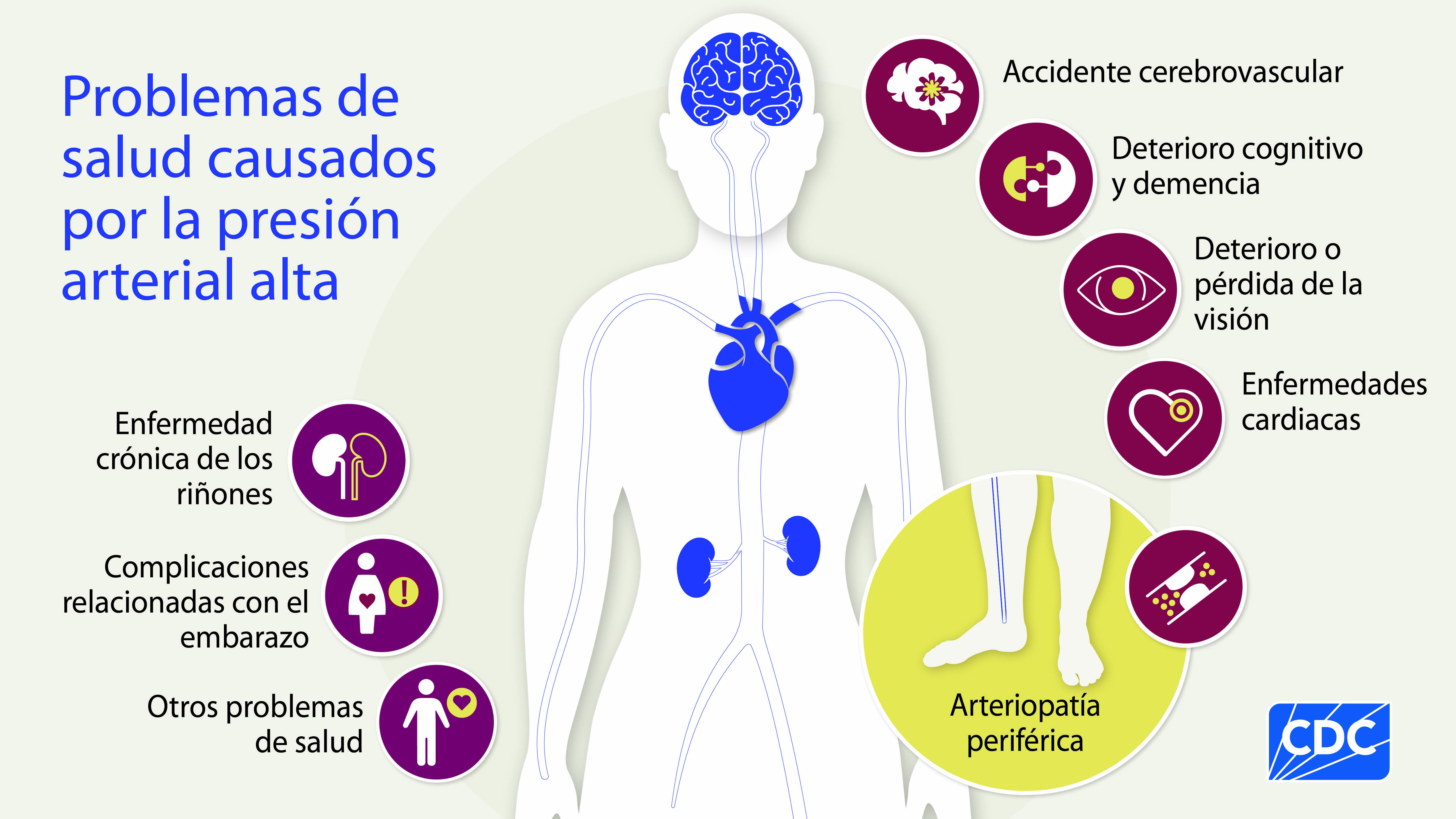 Una ilustración de los problemas de salud causados por la presión arterial alta