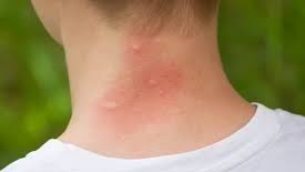 Mosquito bites on the back of a man's neck.