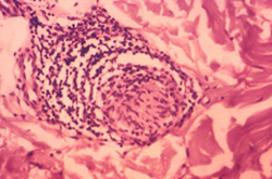 This photomicrograph shows a red circle indicative of the classic histopathologic changes found in a skin section from an individual with leprosy.