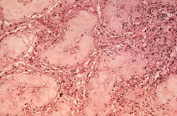 This photomicrograph is shows abnormally shaped cells and reveals some of the histopathologic changes in a specimen of human testicular tissue