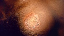 A light-colored skin lesion on the chest of someone with leprosy