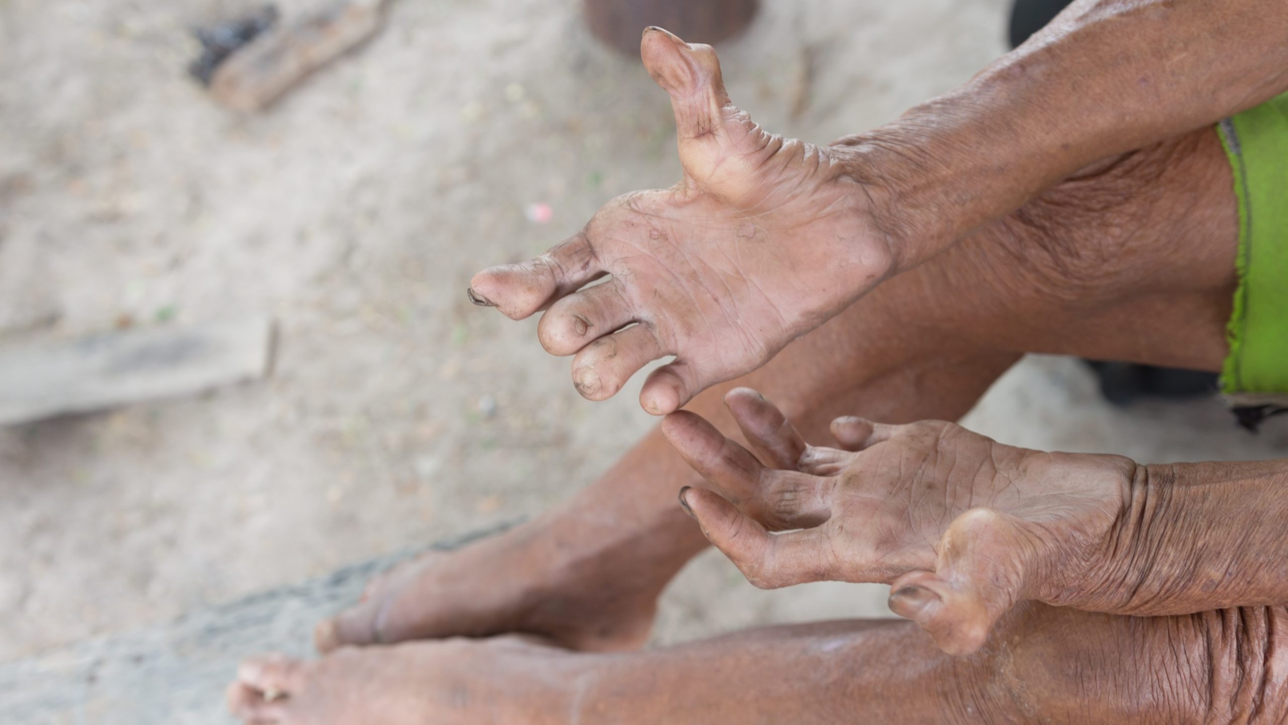 A person with untreated leprosy shows their disabled hands and feet.