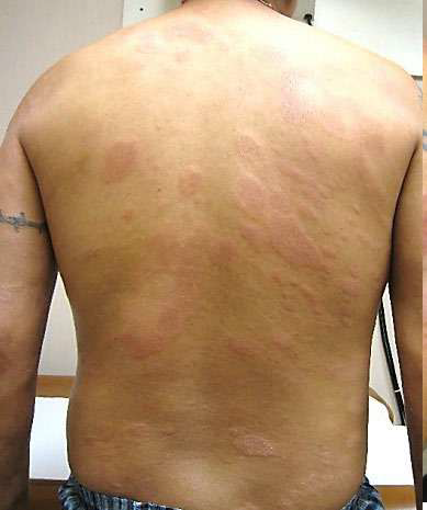Dark lesions indicate BL leprosy on a patient's back