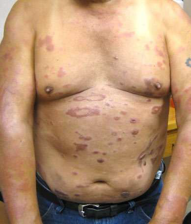 Dark lesions indicate BL leprosy on a patient's chest and trunk