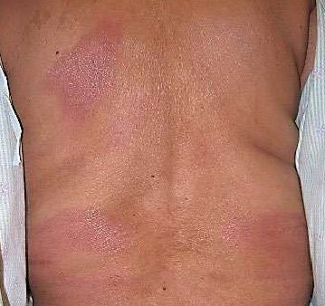Dark, wide lesions on a patient's back characterize BT leprosy