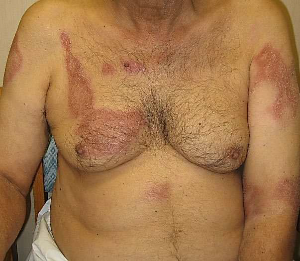 Dark, wide lesions on a patient's trunk characterize BT leprosy