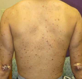 Lepromatous leprosy on a patient's back with numerous lesions