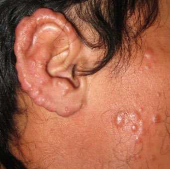 Lepromatous leprosy on a patient's face shows numerous lesions