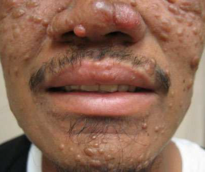 Lesions show lepromatous leprosy on a patient's face