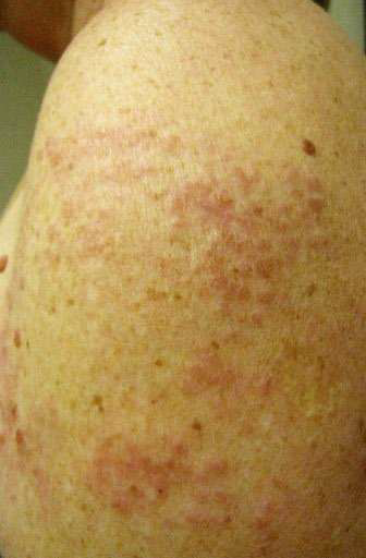 Tuberculoid leprosy shows as a rash of dark skin lesions on a patient's trunk
