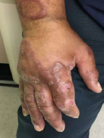 Dark widespread lesions on a hand with clearly defined areas of central healing with somewhat less-defined outer edges