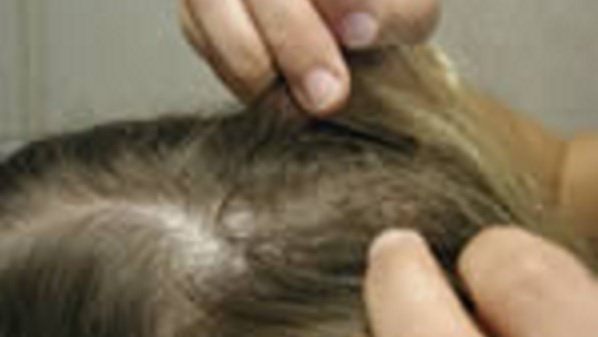 — title missing — Head Lice Examination